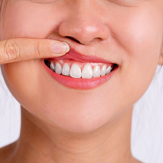 gum recession 2024 543 1 - Viera Dental Arts | Dentist in Melbourne FL gum recession 2024 543 1 - Viera Dental Arts | Dentist in Melbourne FL