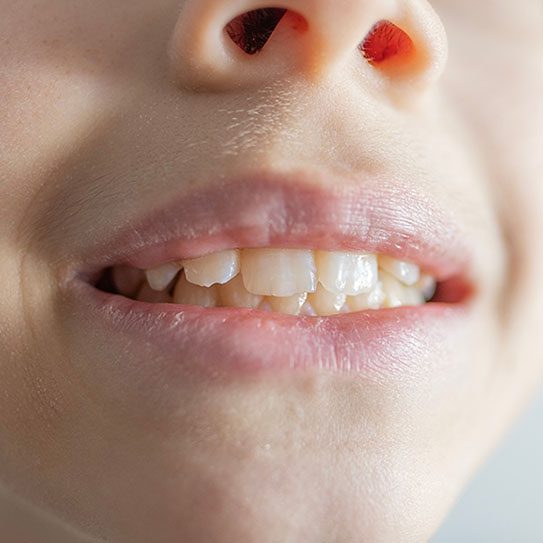 child gum disease 2024 543 1 - Viera Dental Arts | Dentist in Melbourne FL child gum disease 2024 543 1 - Viera Dental Arts | Dentist in Melbourne FL