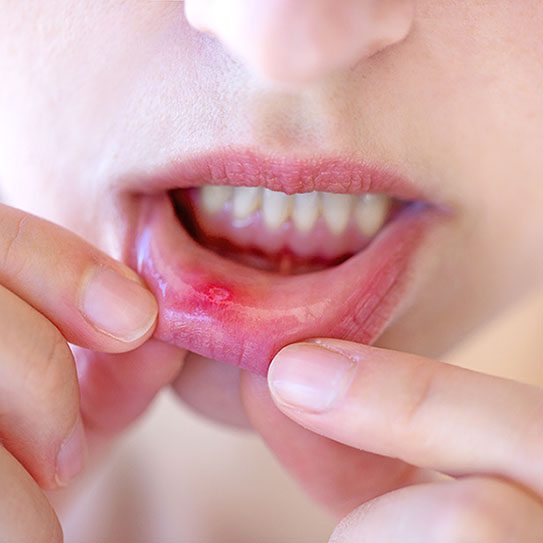 canker sore 2025 543 1 - Viera Dental Arts | Dentist in Melbourne FL canker sore 2025 543 1 - Viera Dental Arts | Dentist in Melbourne FL