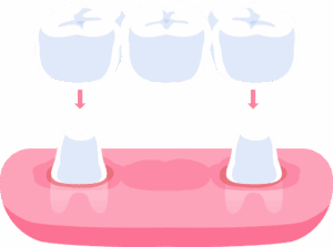 AdobeStock 1580137295 - Viera Dental Arts | Dentist in Melbourne FL Traditional dental bridges teeth illustration design. Dental care concept.