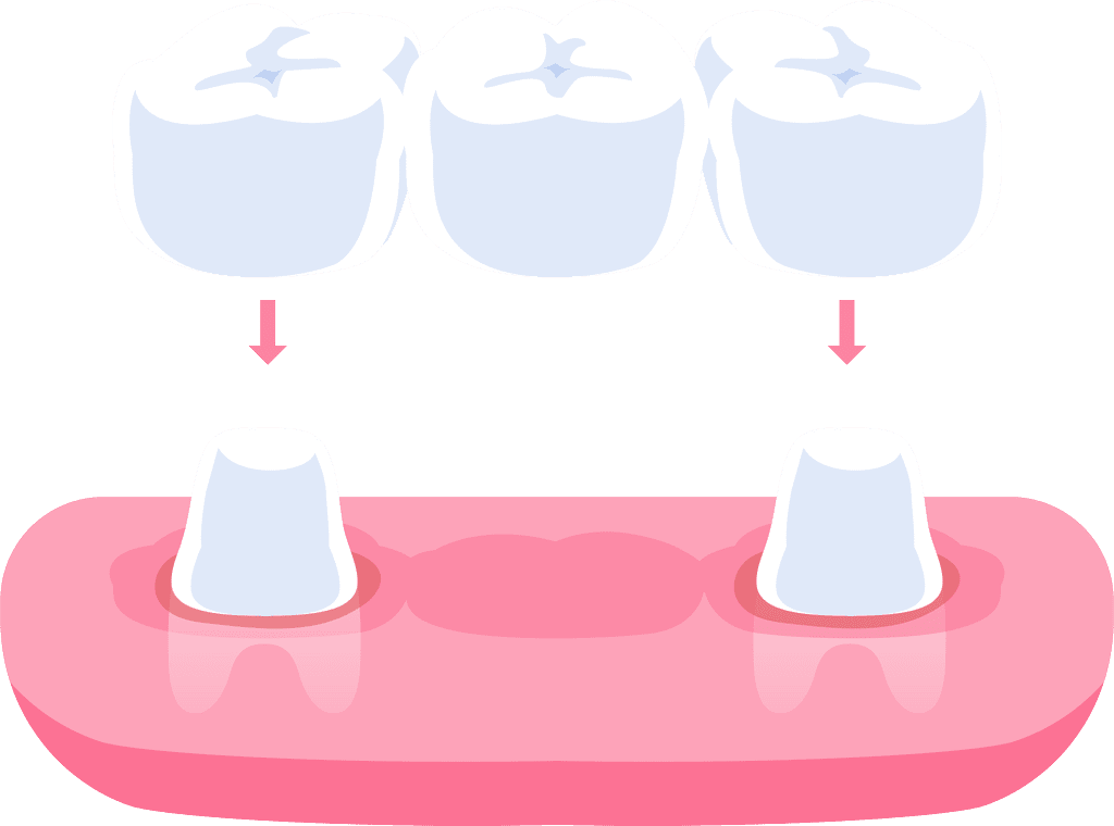 AdobeStock 1580137295 - Viera Dental Arts | Dentist in Melbourne FL Traditional dental bridges teeth illustration design. Dental care concept.