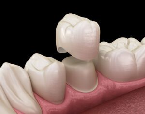 AdobeStock 239374670 - Viera Dental Arts | Dentist in Melbourne FL Dental crown premolar tooth assembly process. Medically accurate 3D illustration of human teeth treatment