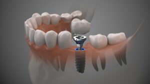 AdobeStock 262324327 - Viera Dental Arts | Dentist in Melbourne FL Tooth human implant. On1 concept. Dental prosthetic innovation.