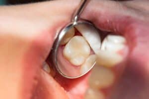 AdobeStock 187063042 - Viera Dental Arts | Dentist in Melbourne FL two chewing side teeth of the upper jaw after treatment of caries. Restoration of the chewing surface with a photopolymer filling material using the Rubber Dam system